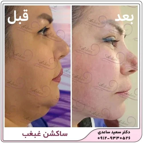 عوارض جراحی ساکشن غبغب چیست؟