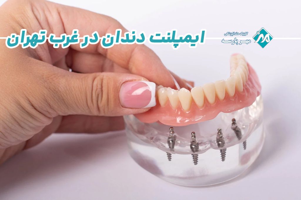 ایمپلنت اقساطی در غرب تهران