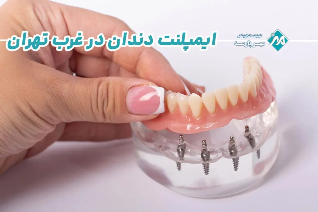 ایمپلنت اقساطی در غرب تهران